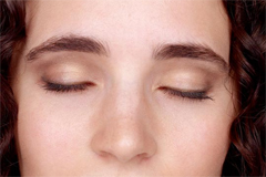 Ptosis Treatment | Blepharoplasty | BOTOX® | Juvéderm®