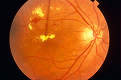 Diabetic Retinopathy | Macular Degeneration Treatment | Retinal Detachment Treatment