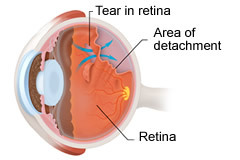 Diabetic Retinopathy | Macular Degeneration Treatment | Retinal Detachment Treatment